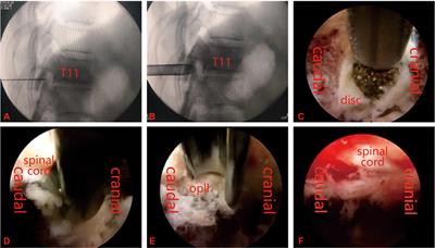 Clinical Efficacy of Endoscopic-Assisted Resection of Single-Segment Ossification of the Posterior Longitudinal Ligament in the Treatment of Thoracic Spinal Stenosis